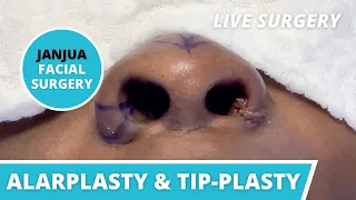 RHINOPLASTY (ALARPLASTY AND TIP-PLASTY) (LIVE SURGERY) - DR. TANVEER JANJUA - NEW JERSEY