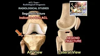 ACL Tears Radiological Evaluation - Everything You Need To Know - Dr. Nabil Ebraheim