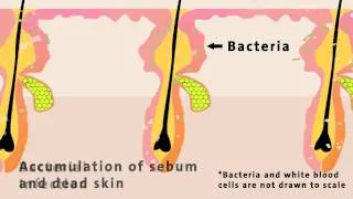 ChemMatters: The Chemistry of Acne