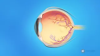 What causes a macular hole?