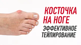 ✅ КОСТОЧКА НА НОГЕ. ЭФФЕКТИВНОЕ ТЕЙПИРОВАНИЕ | Валентин Гайт | Учебный центр BBALANCE