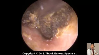 Top Biggest Ear Wax Removal #102 | Ear wax Extraction | Dr. S. Thouk Earwax Specialist