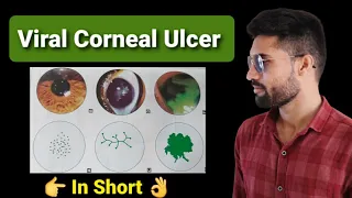 Viral corneal ulcer lecture opthalmology