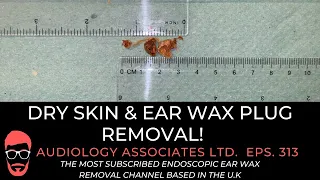 DRY SKIN & EAR WAX PLUG REMOVAL - EP 313