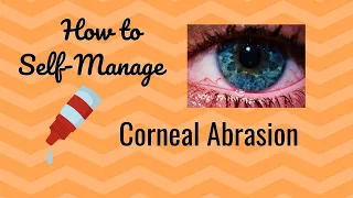How to Treat Your Corneal Abrasion at Home!
