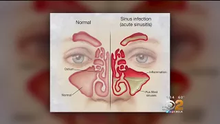 Doctor: Tried And True Methods For Sinus Relief Are Still Best