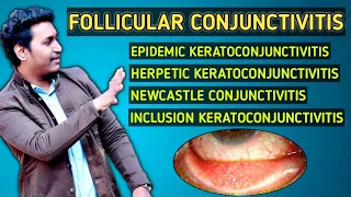 follicular conjunctivitis ||epidemic keratoconjunctivitis || inclusion conjunctivitis ~2021