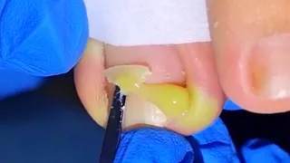 Pus Leaks Out When Huge Ingrown Toenail Gets Removed