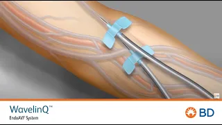 BD WavelinQ Cannulation Motion Graphic