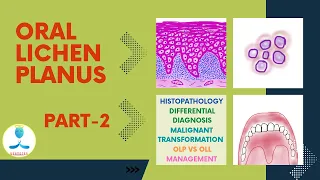 Oral Lichen Planus Part 2 | Histopathology of Lichen Planus | Malignant transformation | Management