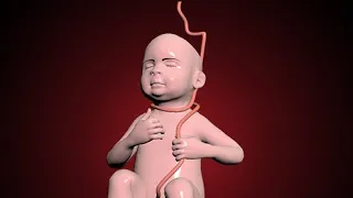 Nuchal cord - umbilical cord becomes wrapped around the fetal neck 360 degrees. #education