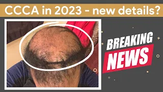 CCCA in 2023 [Latest Updates and Research] #cccaalopecia #hairlosstreatment #hairloss
