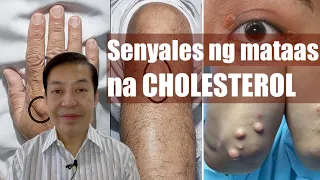 Mga senyales na mataas ang cholesterol