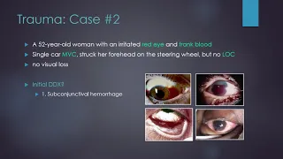 Trauma of the Anterior Segment Part 1