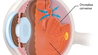 Отслойка сетчатки глаза - причины, симптомы (признаки) и лечение
