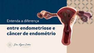 Entenda a diferença entre endometriose e câncer de endométrio