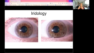 Iridology - Introduction to the RIGHT way to do and iris assessment