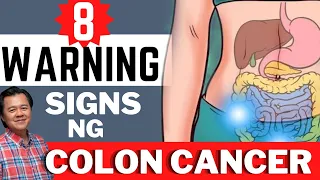 8 Warning Signs ng Colon Cancer - Payo ni Doc Willie Ong