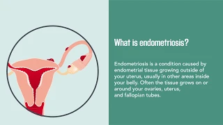 Endometriosis: Causes, Symptoms, Diagnosis, and Treatment | Merck Manual Consumer Version