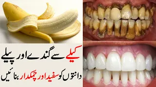 Kale Se Peele Dant Safed Karne Ka Tarika | Teeth Whitening |Peele Danton Ka ilaj Dr Sharafat Ali New