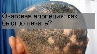 Очаговая алопеция: как быстро лечить?