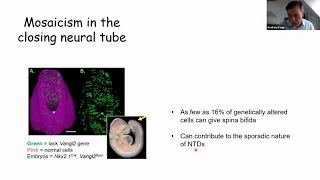 ISPD Virtual Education Series - Spina Bifida