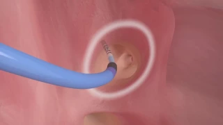 Atrial Fibrillation Catheter Ablation Animation