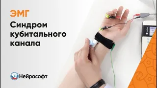 ЭМГ: Диагностика Синдрома Кубитального Канала (Локтевой Нерв)