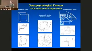 Lewy Body Dementia Update  Diagnosis, Management, and Future Directions