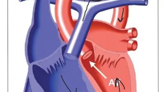 Pediatric Echo for the Adult Technologist-PDA (Patient Ductus Arteriosus)  2018