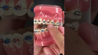 How to Floss Properly with Braces On