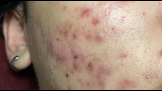 Make your Acne Treatment Huong Da Nang#507 | acne 2022