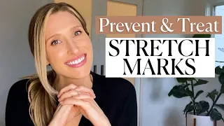 Can You Prevent Stretch Marks? A Dermatologist Explains Causes & Treatments | Dr. Sam Ellis