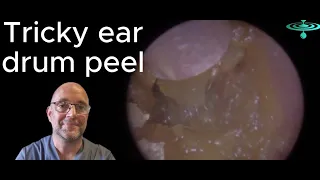Tricky ear drum peel - Episode 113 #ear #earwax #earwaxextraction #earwaxclinic