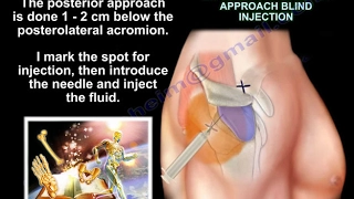 Injections Around The Shoulder - Everything You Need To Know - Dr. Nabil Ebraheim