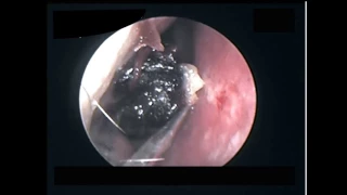 Endoscopic Sinus Debridement