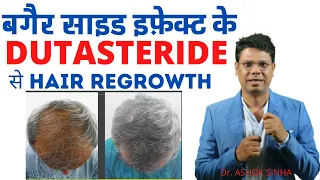 बगैर साइड इफ़ेक्ट के DUTASTERIDE से HAIR REGROWTH- Dr. ASHOK SINHA