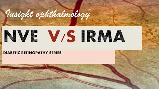IRMA vs NVE || intraretinal microvascular abnormality vs neovascularisation