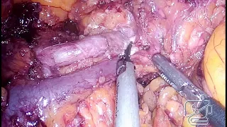 Laparoscopic spleen preserving distal pancreatectomy with vaginal specimen extraction