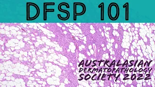 DFSP 101 (dermatofibrosarcoma protuberans - sarcoma that mimics cyst lipoma scar) pathology dermpath