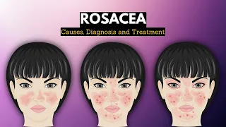 Rosacea, Causes, Signs and Symptoms, Diagnosis and Treatment.