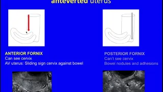 Webinar Replay: How to diagnose Endometriosis on Ultrasound