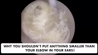 HUGE COTTON WOOL BLOCKAGE REMOVED FROM PATIENTS EAR - Ep 22