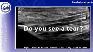 Tips for visualizing small tears in the tendons or ligaments on your MSK Ultrasound exam