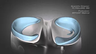 Knee Arthroscopy - Meniscal Surgery