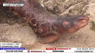 MIRACLE CAUGHT ON CAMERA: Watch A Rotting Leg Heal After Prayer!!!