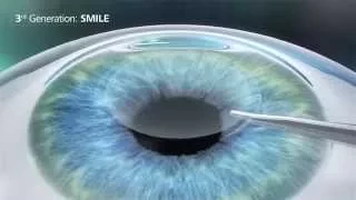 Relex SMILE versus LASIK versus PRK en LASEK