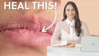 How to Fix Chapped Lips | Tips and Tricks from a Nutritionist