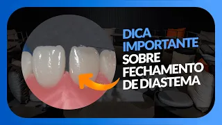 FECHAMENTO DE DIASTEMA