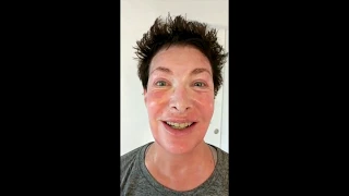 DAY 5: Lauri Kane Documents Her Sculptra and TCA Peel Recovery